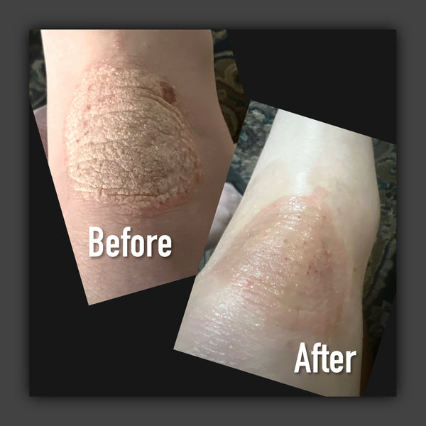 The Outlaw (for rebellious skin/ psoriasis support)